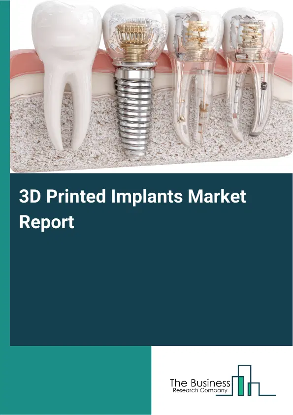 Global 3D Printed Implants Market Report 2026