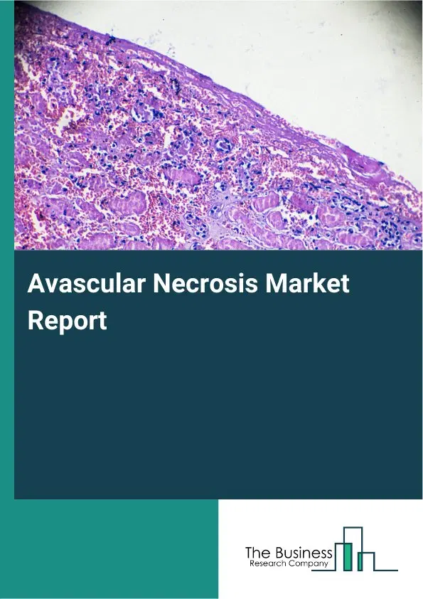 Global Avascular Necrosis Market Report 2026