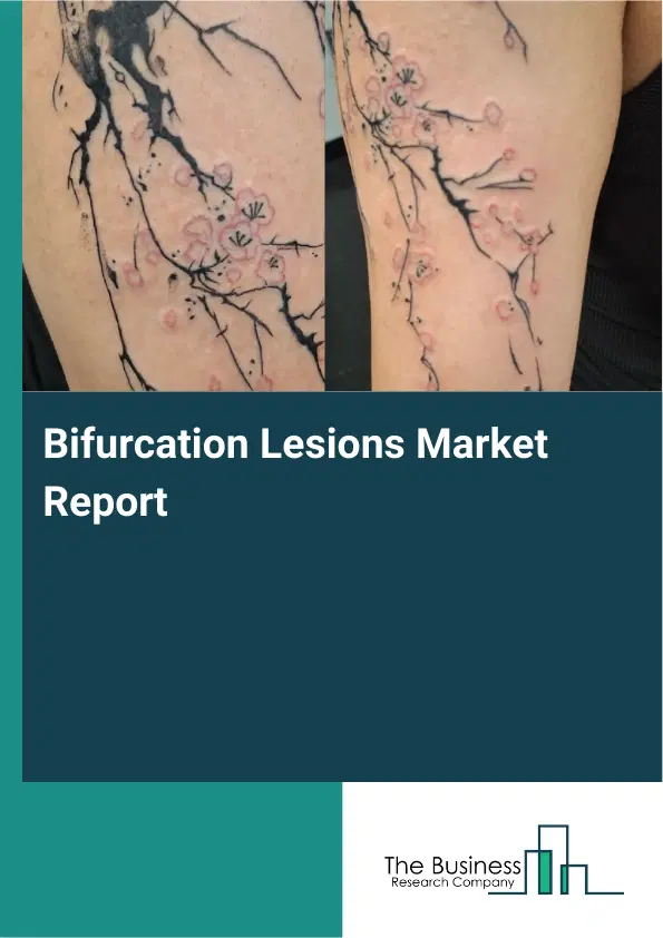 Global Bifurcation Lesions Market Report 2026