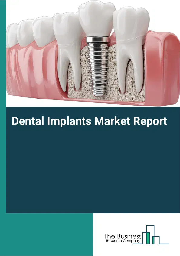 Global Dental Implants Market Report 2026