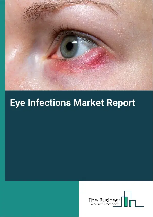 Global Eye Infections Market Report 2026