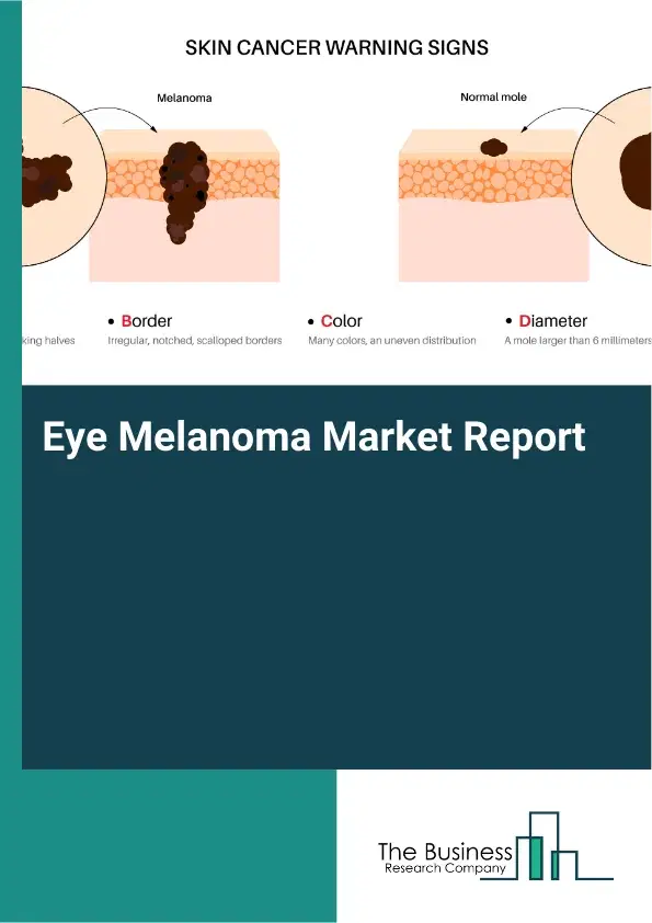Global Eye Melanoma Market Report 2026