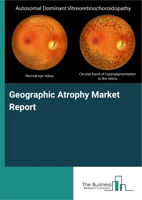 Global Geographic Atrophy Market Report 2026