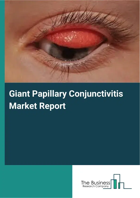 Global Giant Papillary Conjunctivitis Market Report 2026