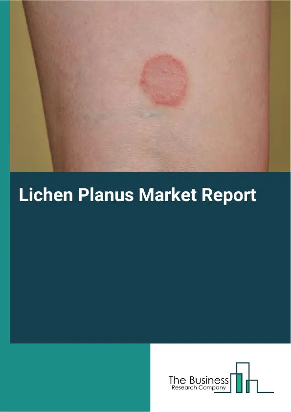Global Lichen Planus Market Report 2026