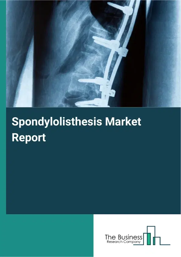 Global Spondylolisthesis Market Report 2026