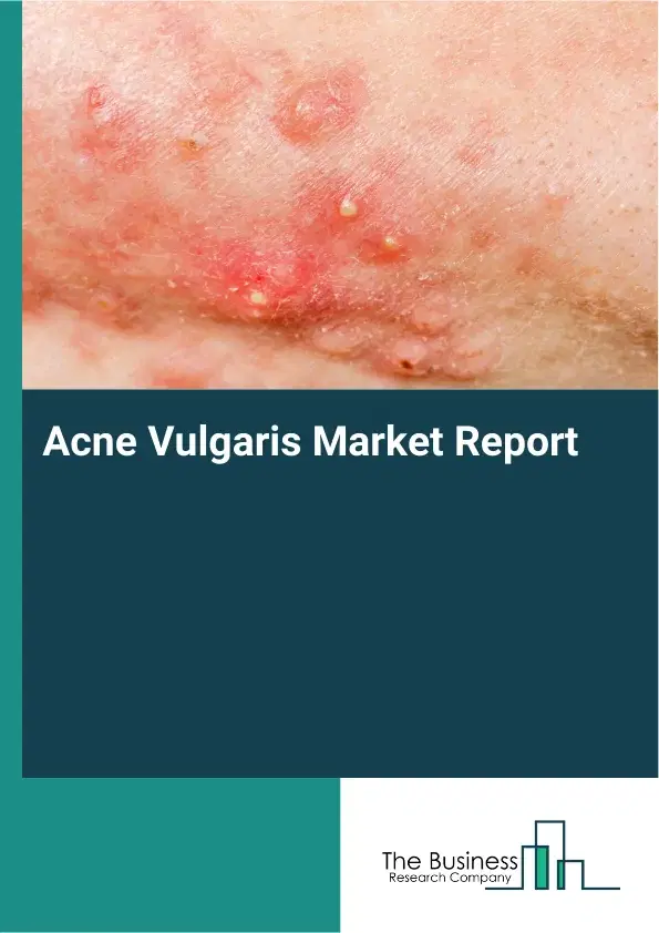 Global Acne Vulgaris Market Report 2026 Global Acne Vulgaris Market Report 2026