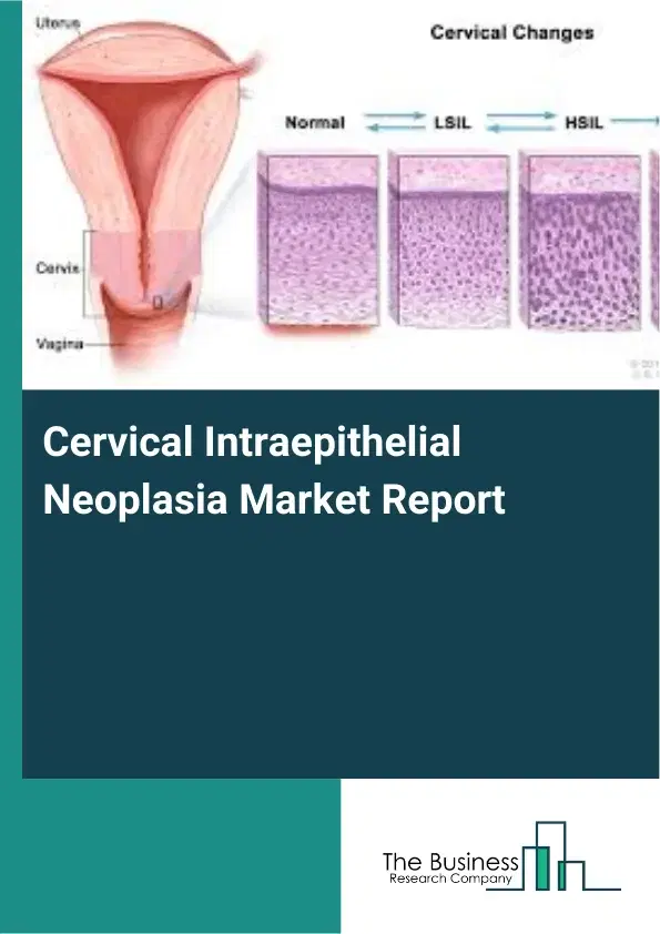Global Cervical Intraepithelial Neoplasia Market Report 2026 Global Cervical Intraepithelial Neoplasia Market Report 2026
