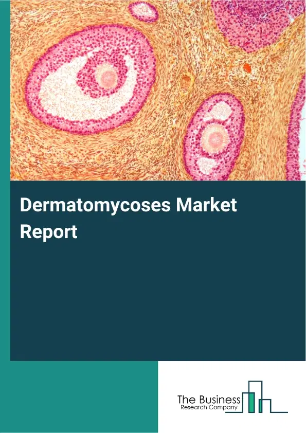 Global Dermatomycoses Market Report 2026 Global Dermatomycoses Market Report 2026