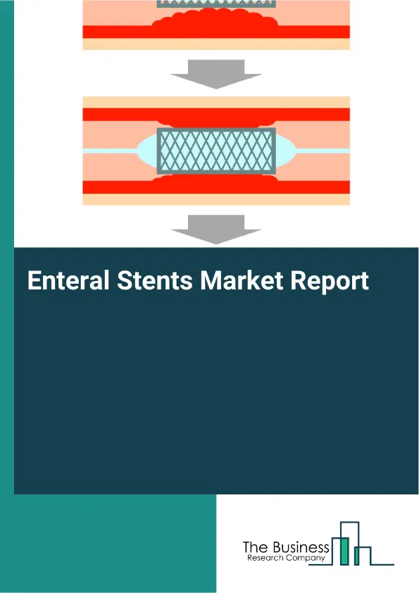 Global Enteral Stents Market Report 2026 Global Enteral Stents Market Report 2026