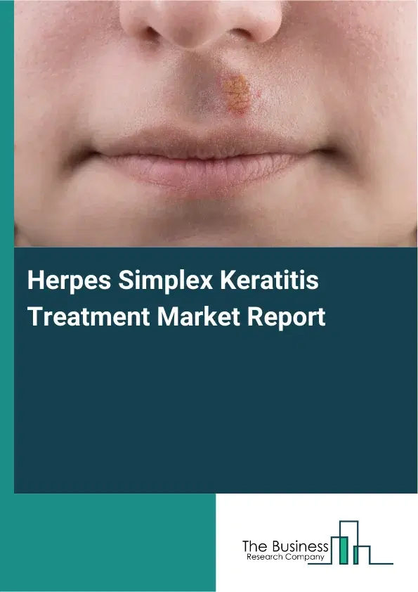 Global Herpes Simplex Keratitis Treatment Market Report 2026 Global Herpes Simplex Keratitis Treatment Market Report 2026