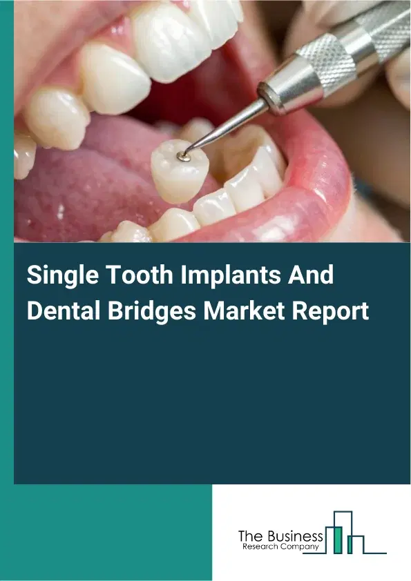 Global Single Tooth Implants And Dental Bridges Market Report 2026 Global Single Tooth Implants And Dental Bridges Market Report 2026