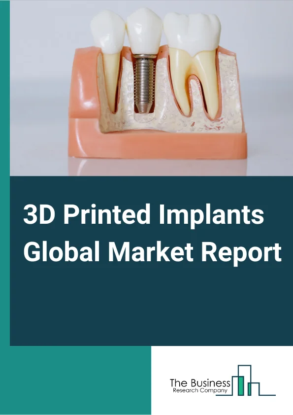 3D Printed Implants Market Report Infographic Image