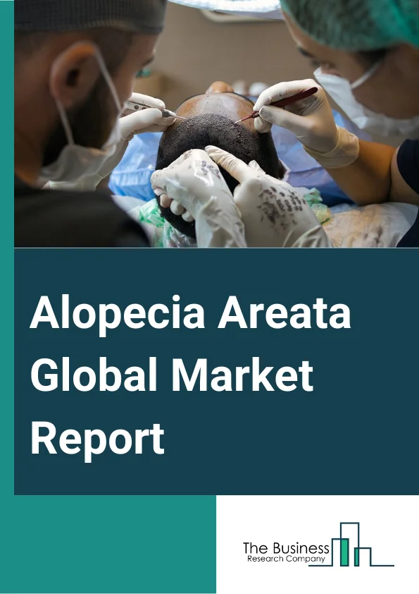 Alopecia Areata