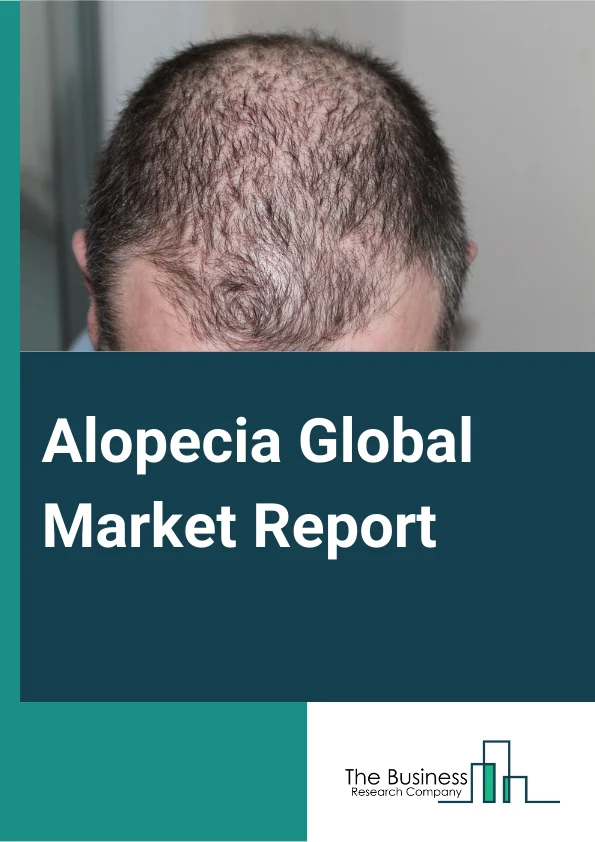 Alopecia Global Market Report 2024 