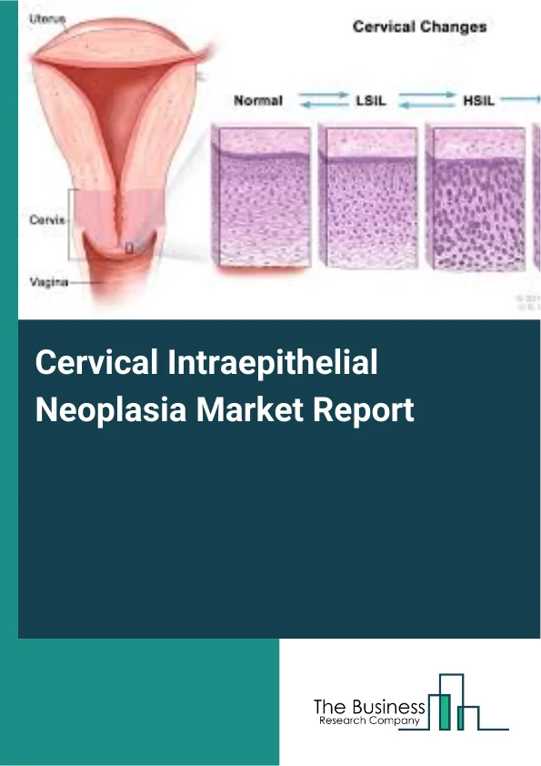 Cervical Intraepithelial Neoplasia Market Report Infographic Image