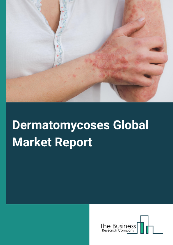 Global Dermatomycoses Market Report 2025