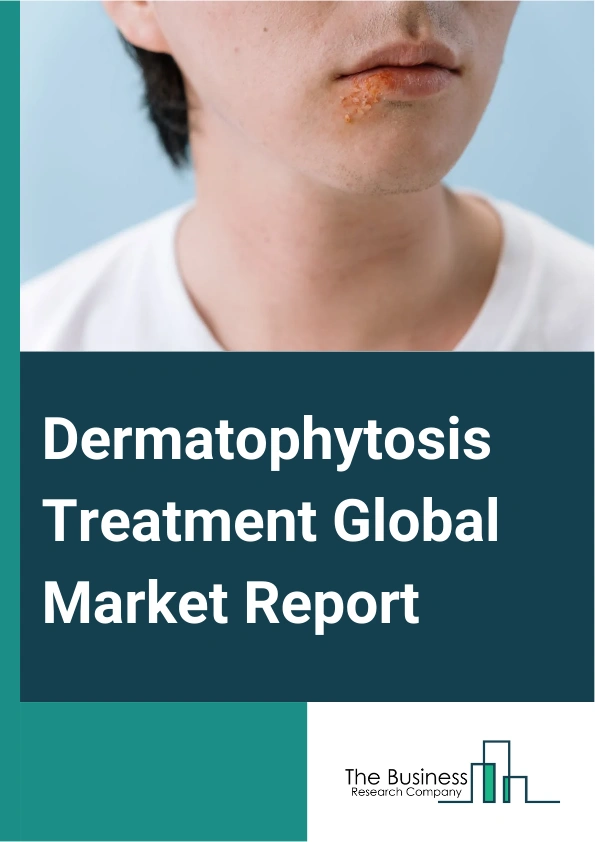 Dermatophytosis Treatment Global Market Report 2025 – By Type (Prescribed, Over The Counter), By Product Type (Anti-infective, Antifungal, Steroids, Other Product Types), By Route Of Administration (Oral, Topical), By En...