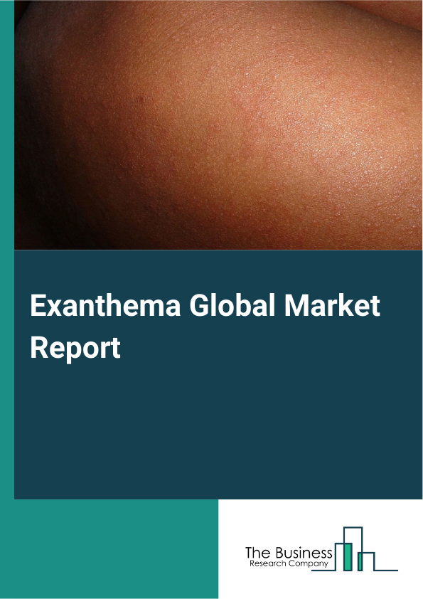 Global Exanthema Market Report 2025