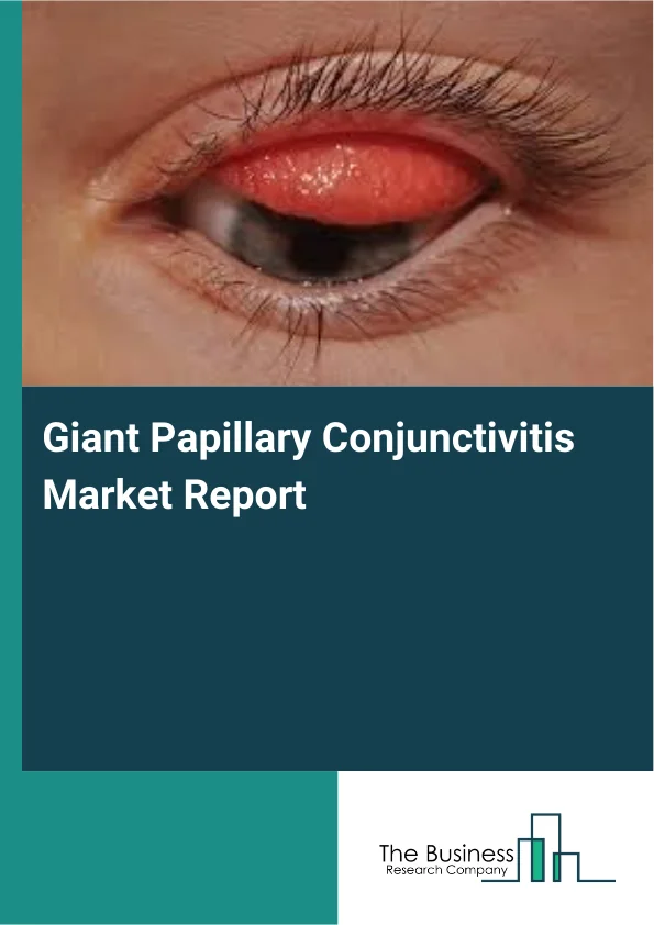 Giant Papillary Conjunctivitis Market Report Infographic Image