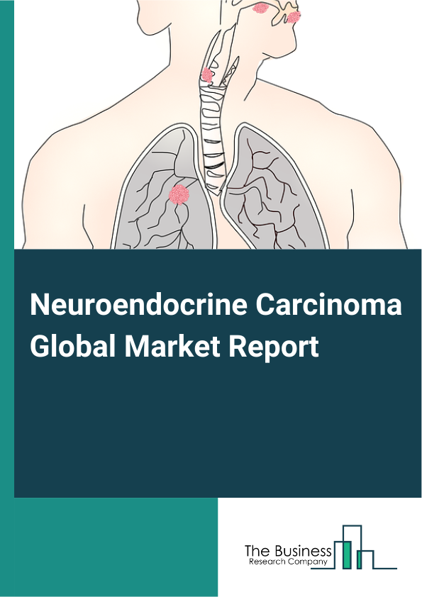Global Neuroendocrine Carcinoma Market Report 2025