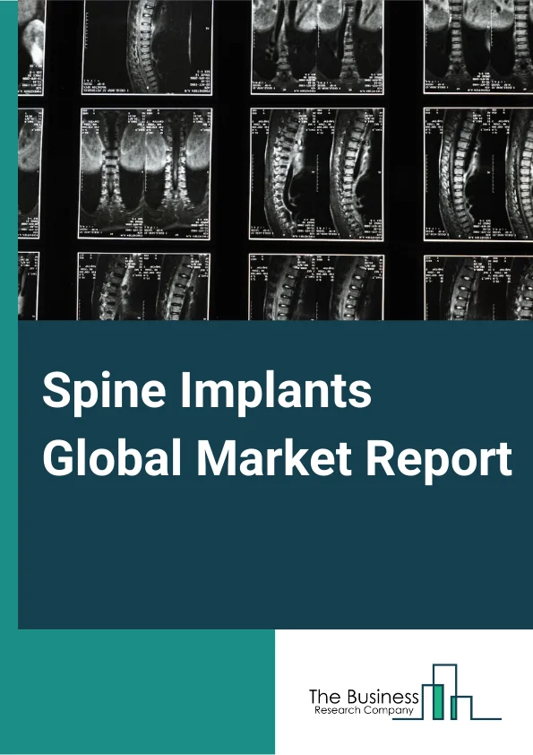 Spine Implants Global Market Report 2023 – By Product (Spinal Fusion Devices, Non-Fusion Devices/Motion Preservation Devices, Vertebral Compression Fracture (VCF) Treatment Devices, Spinal Bone Stimulators, Spine Biologics), By Procedure (Open Surgery, Minimally Invasive Surgery (MIS)), By Material (Metallic, Polymeric, Ceramic), By End Use (Hospitals, Specialty Orthopedic And Spine Centers, Ambulatory Surgical Centers) – Market Size, Trends, And Global Forecast 2023-2032