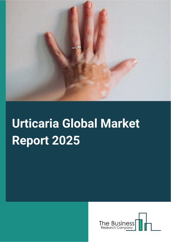 Global Urticaria Market Report 2025